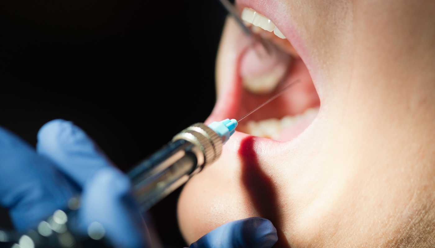 Anestesia Local en Odontología: Guía Técnica para Profesionales y Estudiantes