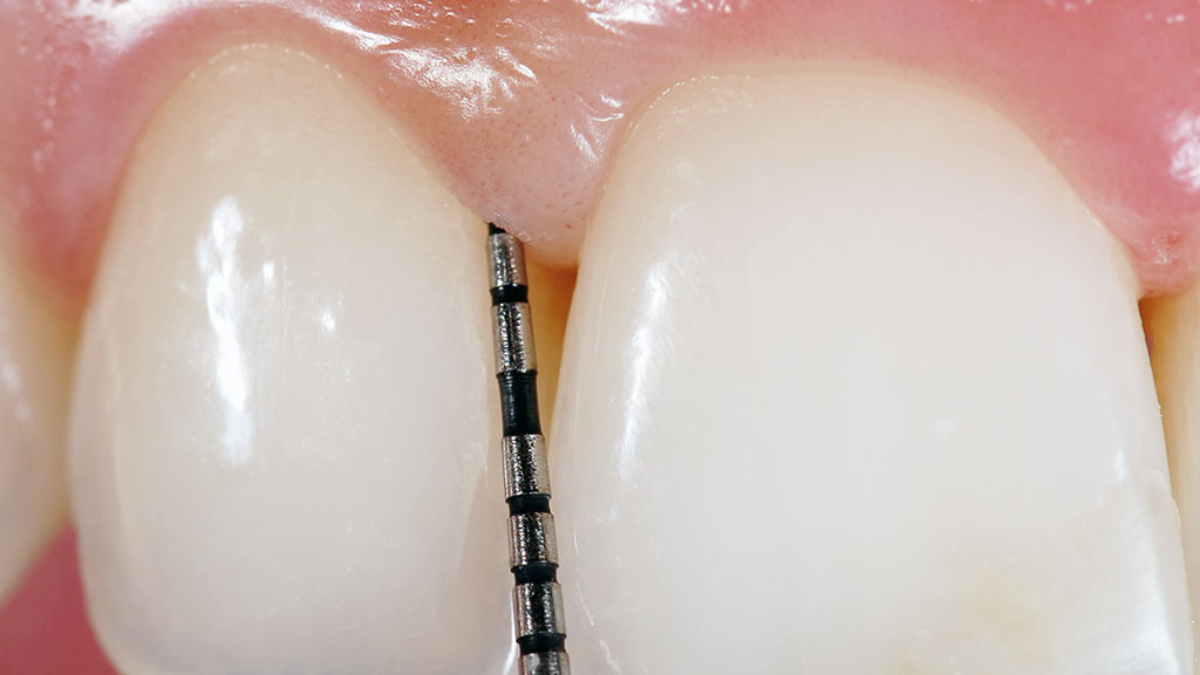 5 Consejos esenciales para elegir una sonda periodontal