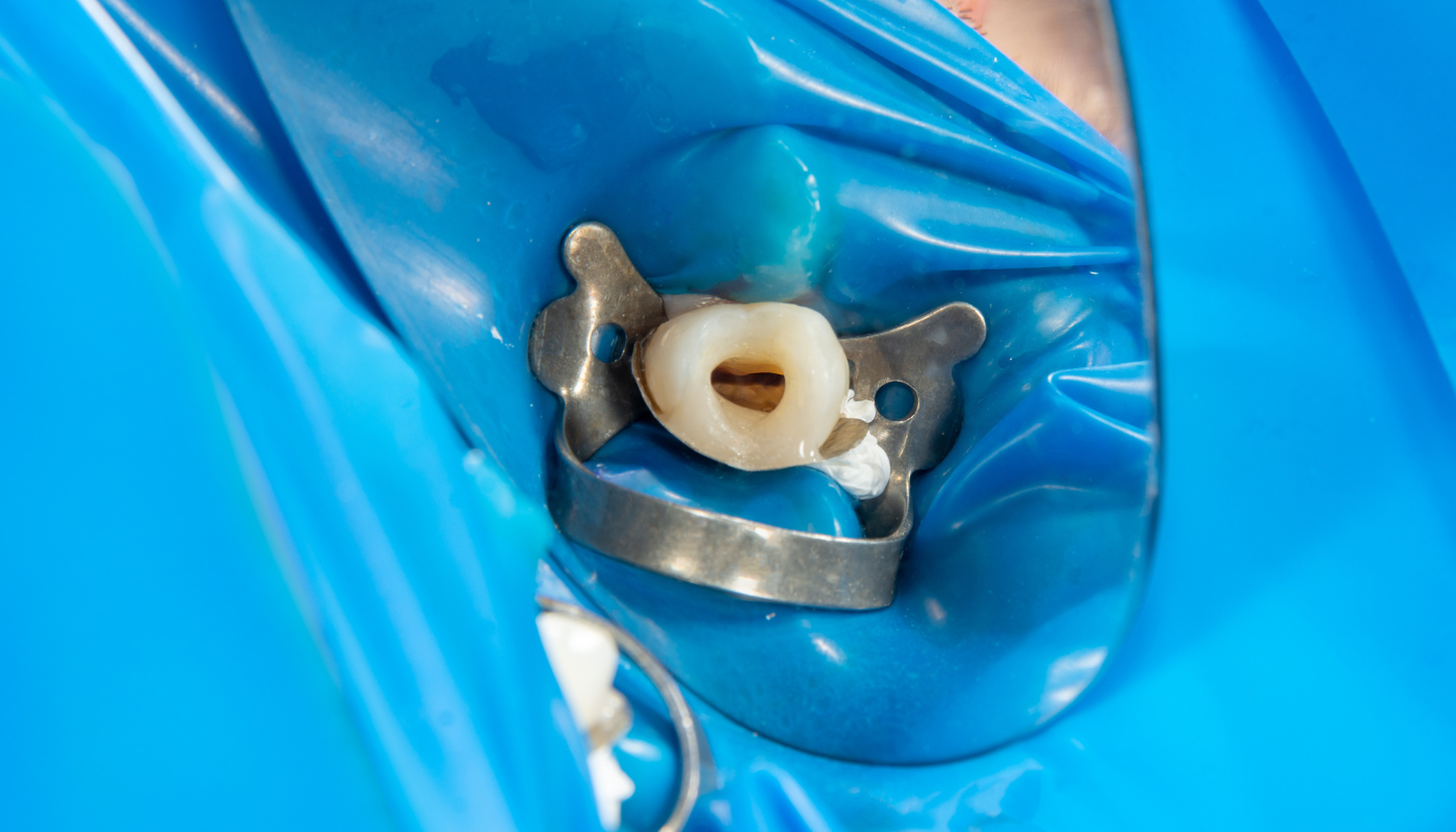 Soluciones Irrigantes en Endodoncia: Fundamentos, Evidencia y Recomendaciones Clínicas