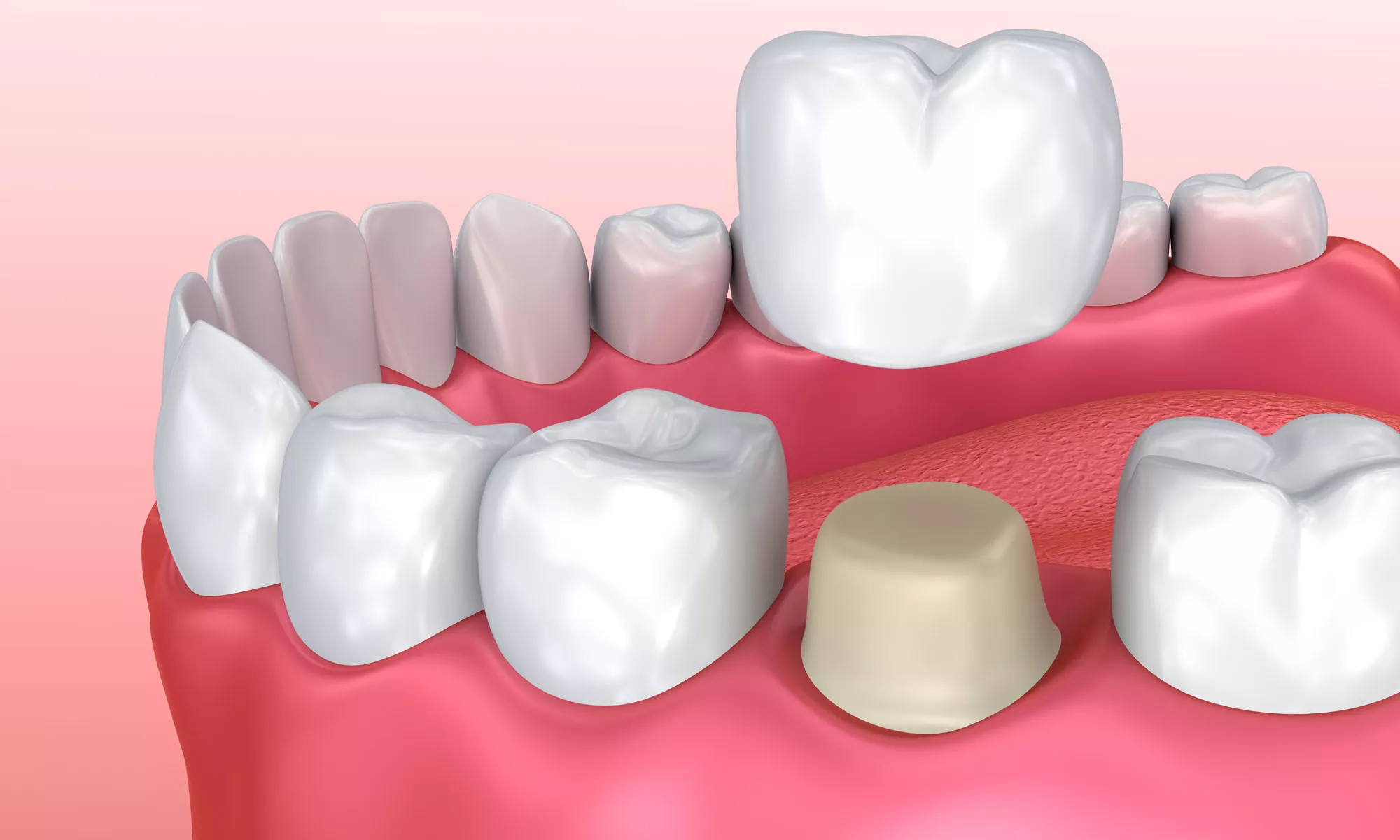 Cemento provisional Odontología