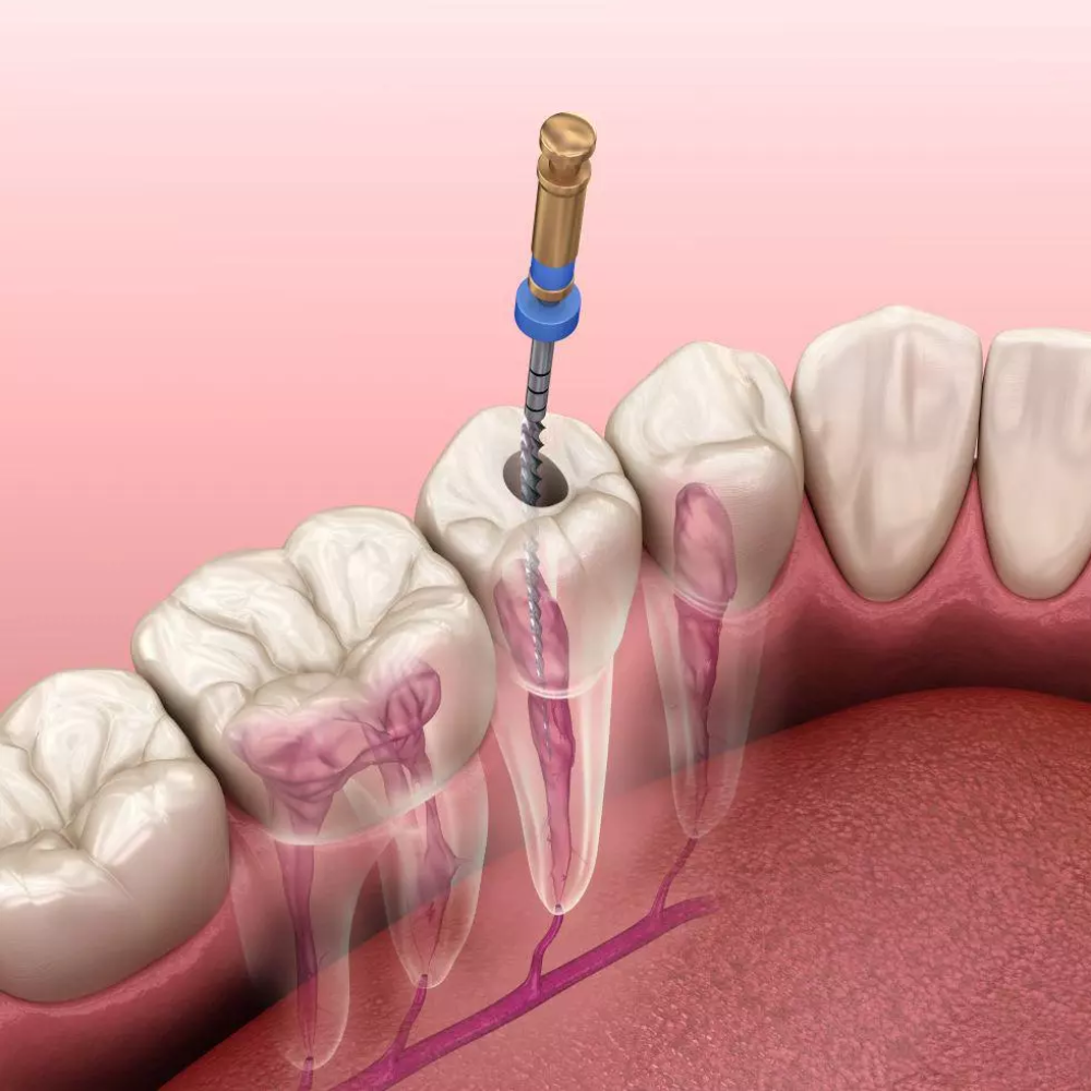 Instrumentos de endodoncia