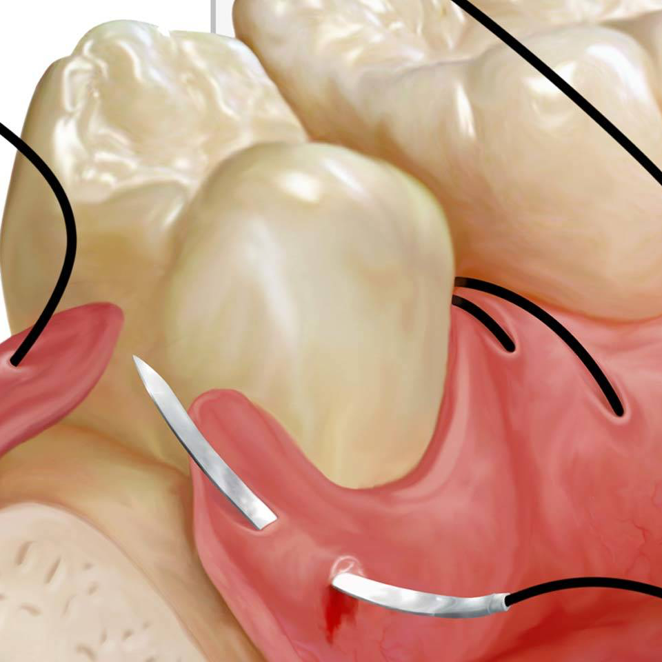 Insumos de cirugía dental