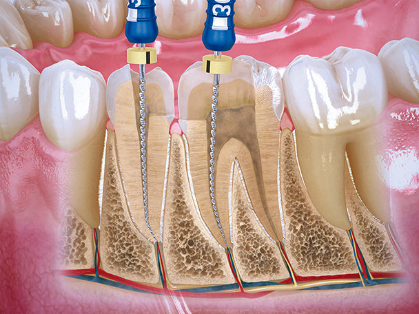 Limas de endodoncia