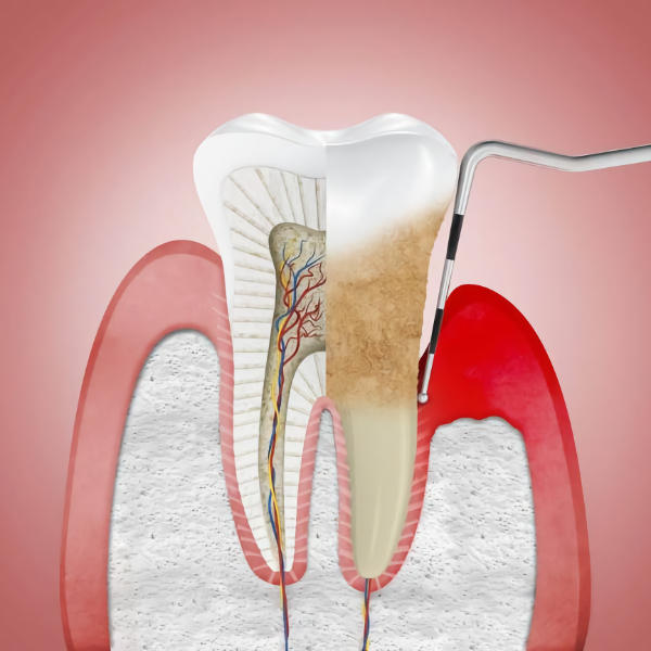 Insumos de periodoncia