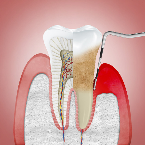 Instrumental de periodoncia