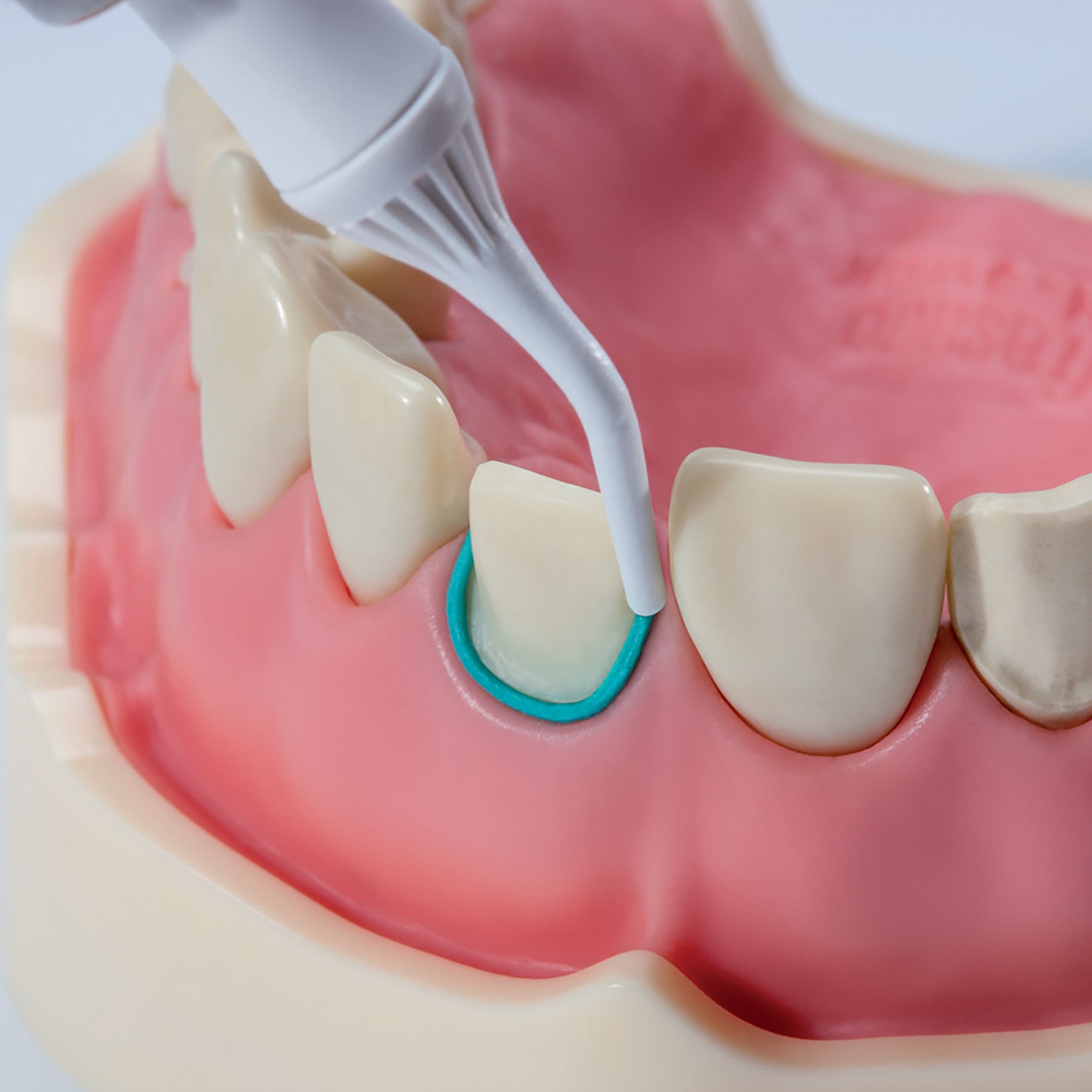 Retracción gingival