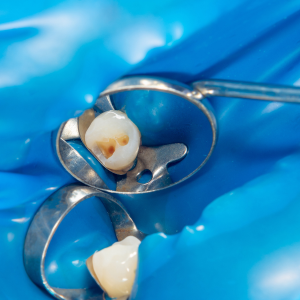 Sellador de conductos radicular - Endodoncia