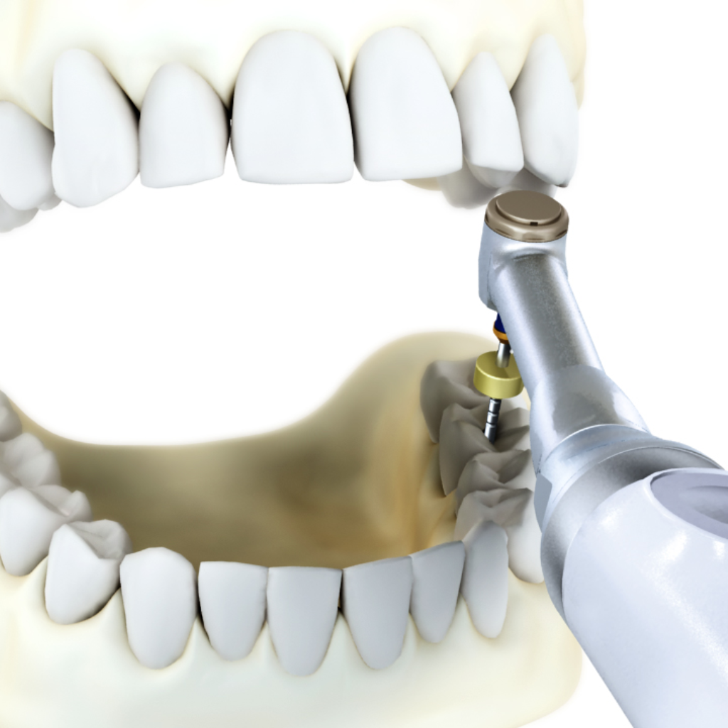 Endo-Mate TC2 Motor de Endodoncia inalámbrico NSK - eksadental